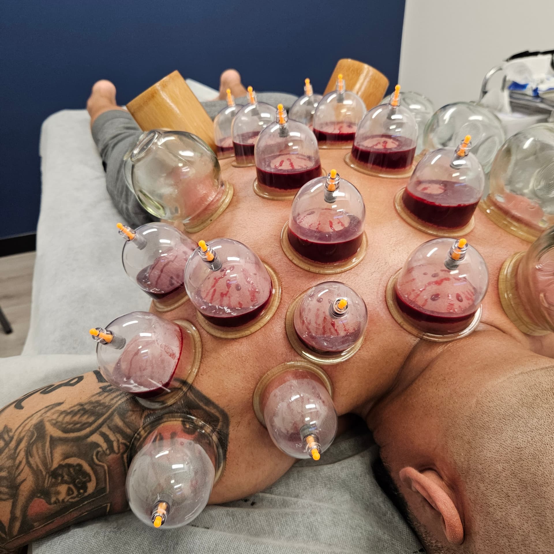 Close view of Hijama cups and traditional cups on a male client's back
