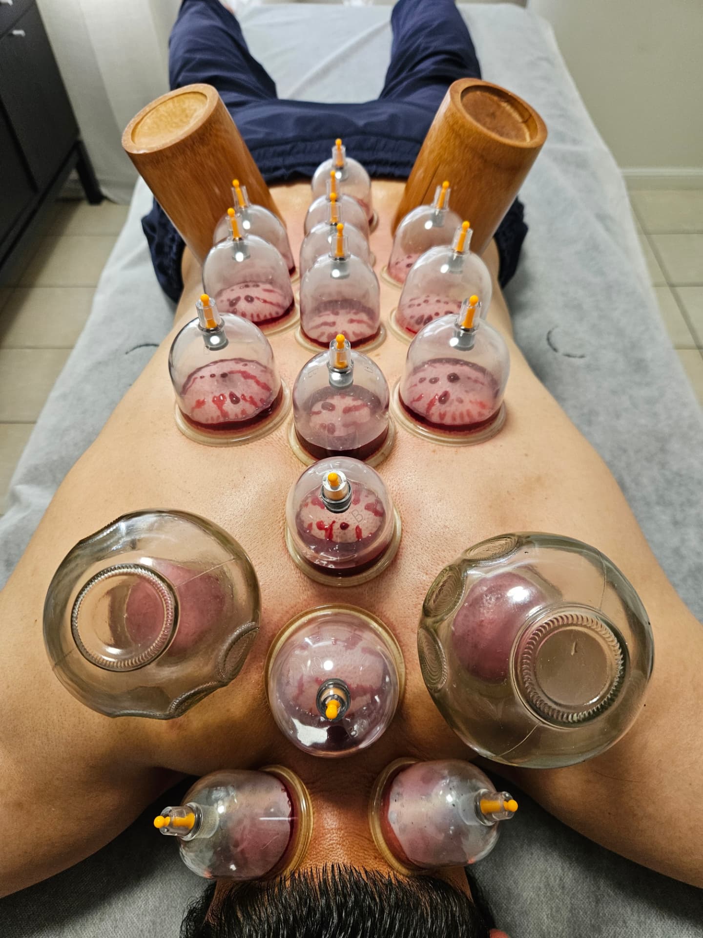 Symmetrical arrangement of Hijama and traditional cups on a male client's back