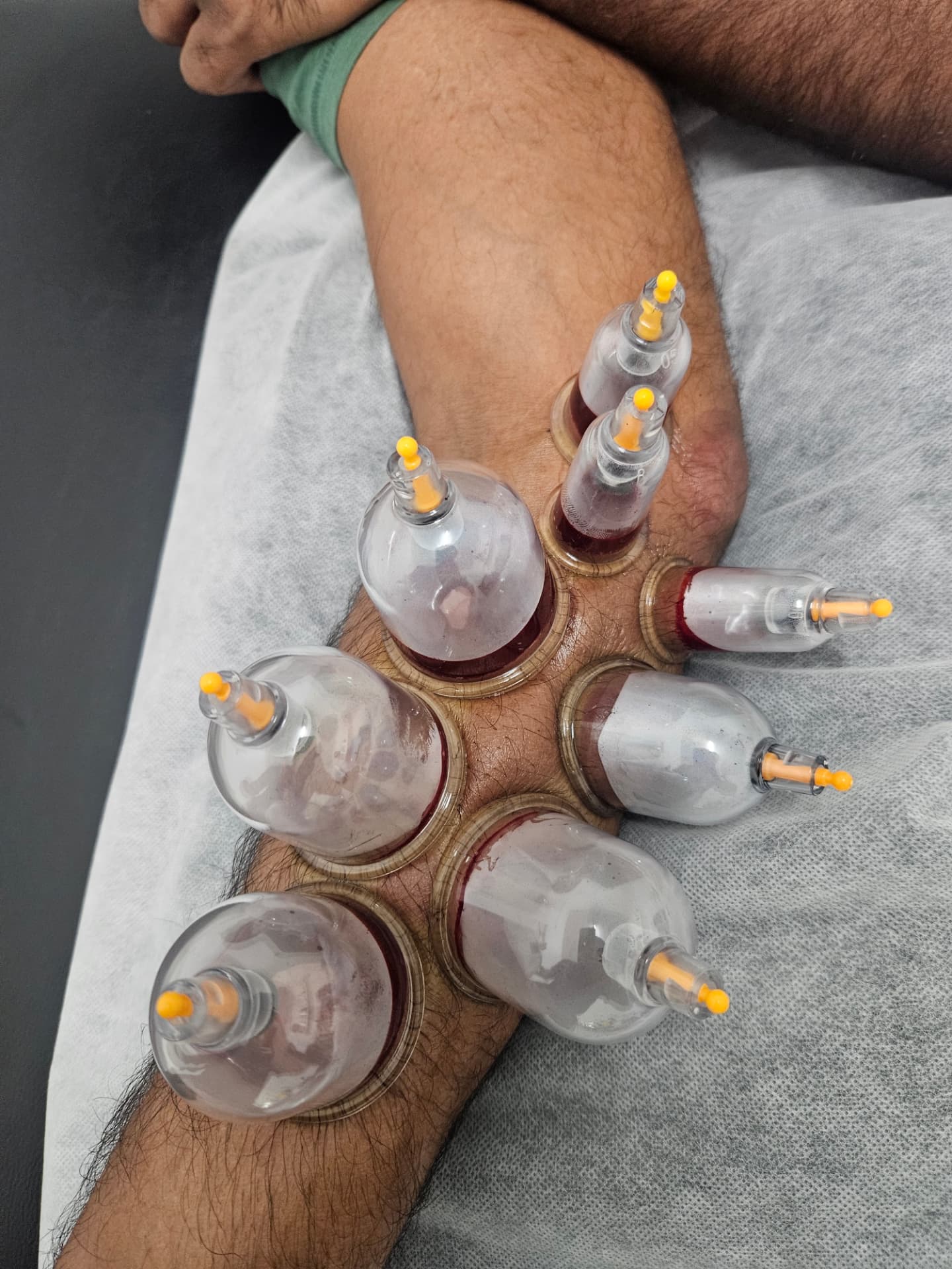 Hijama cups positioned around a male client's knee
