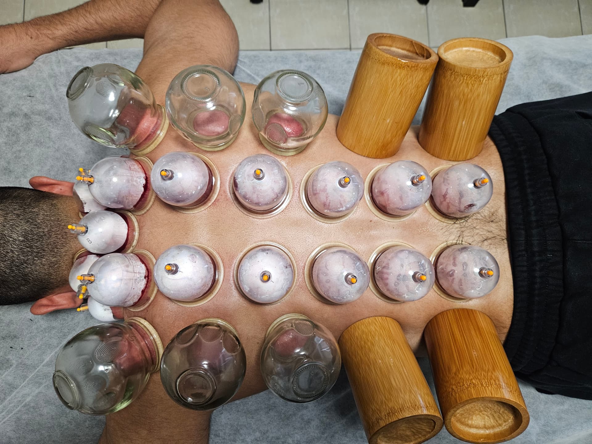 Overhead view of Hijama, glass and bamboo cups across a male client's back