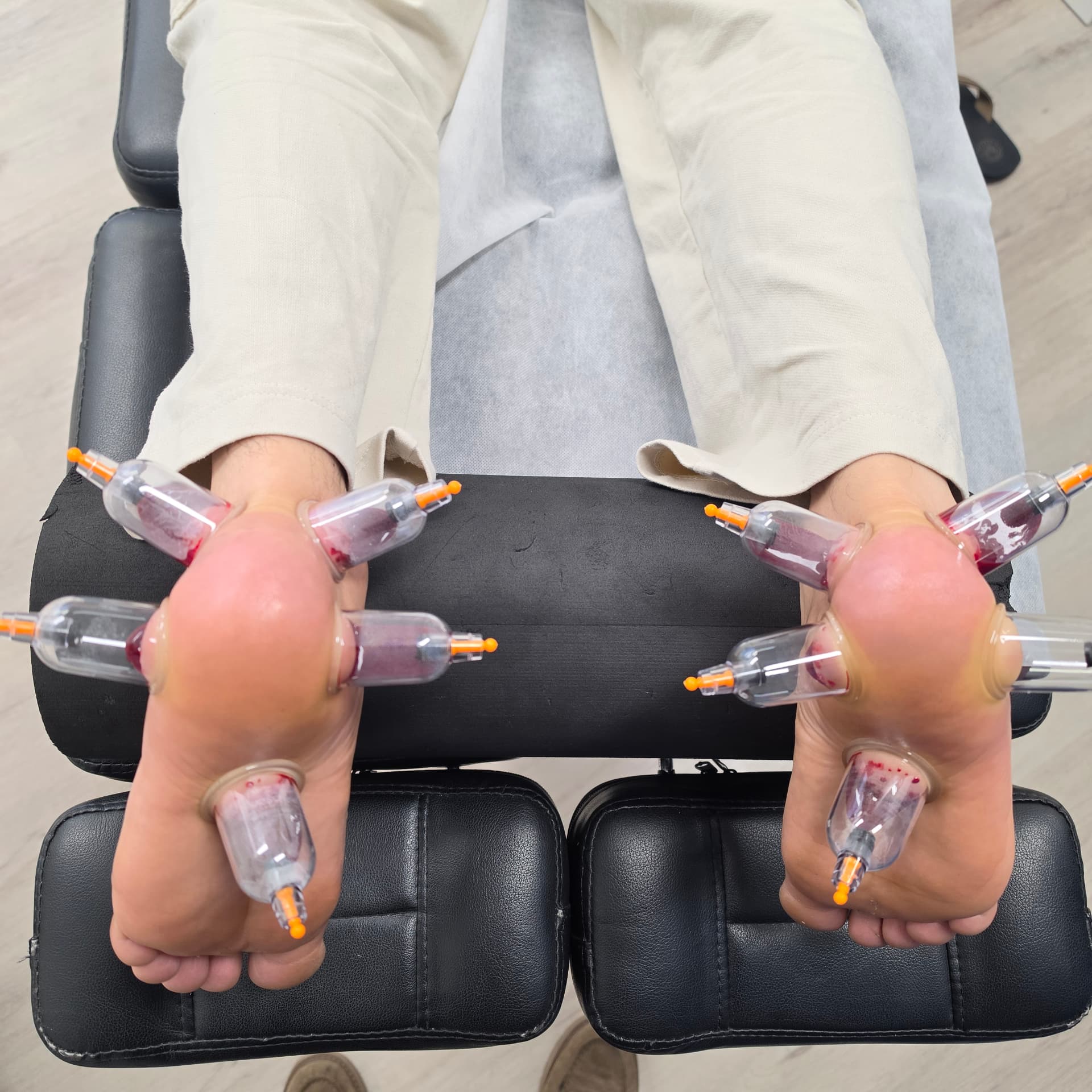Hijama cups applied around the soles and ankles of a client