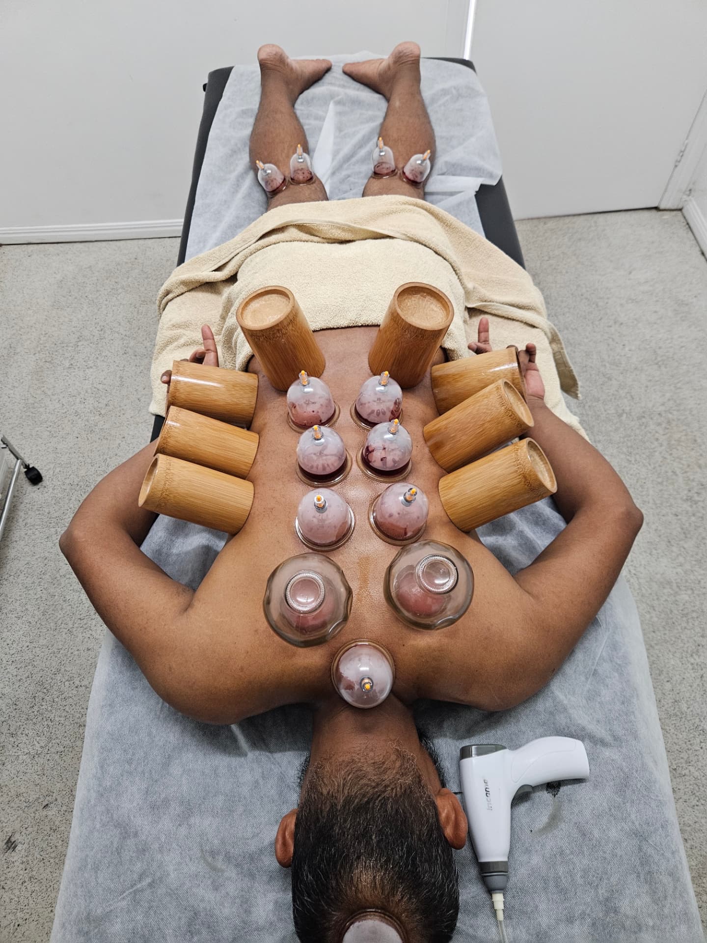 Overhead view of an integrated cupping treatment across a male client's back and legs