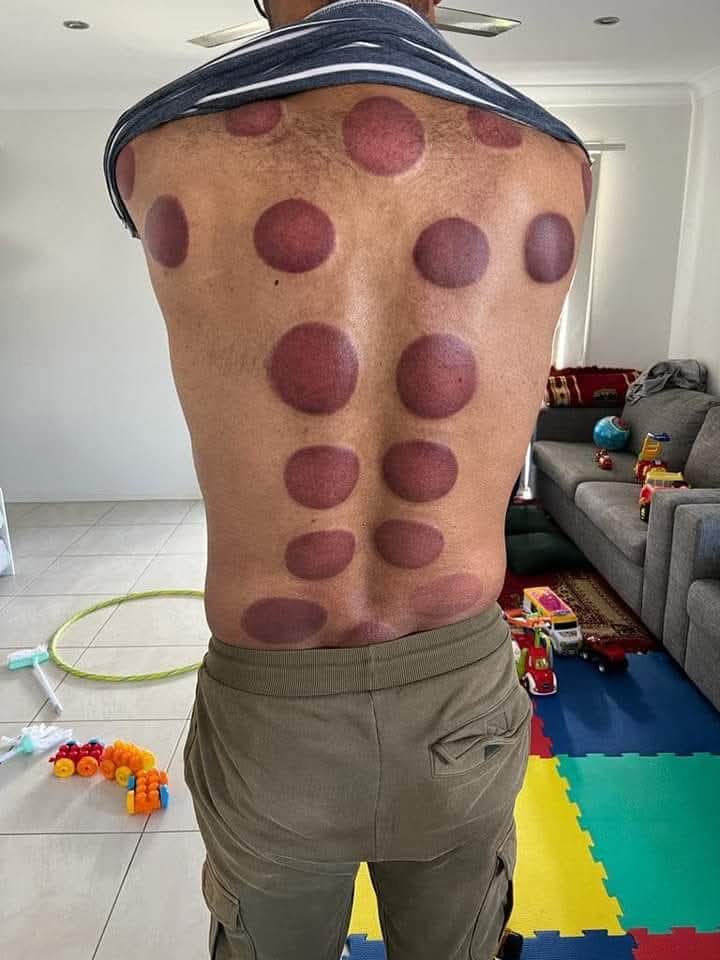 Cupping treatment marks across a male client's back