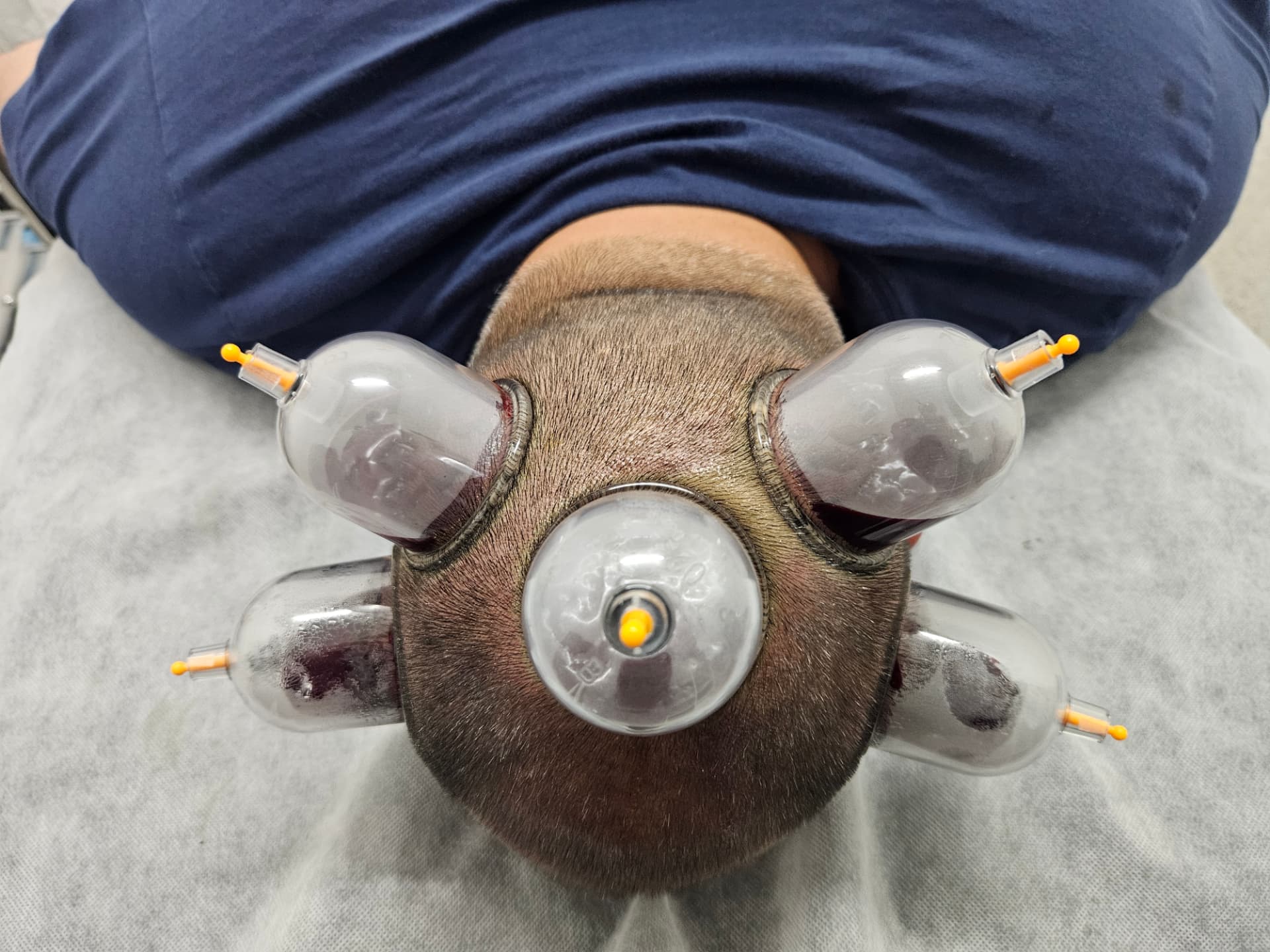 Hijama cups positioned on the back and sides of a male client's head
